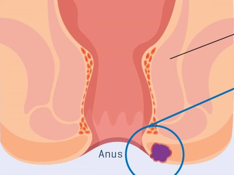 Abcesso perianal: sinais de alarme na mudança da&nbsp;fralda