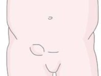 O meu bebé está irritado – será uma hérnia&nbsp;inguinal?